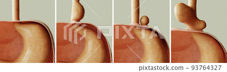 Hiatus hernia - Healthy and 3 types of diaphragmatic hernia - 3D rendering 93764327