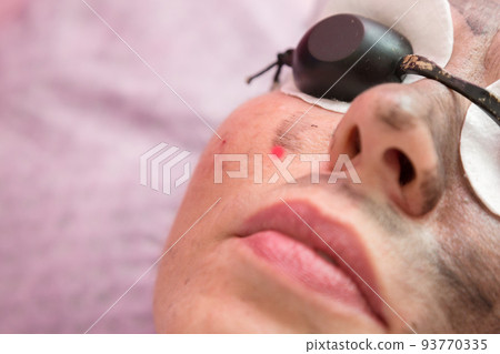 Portrait of an adult woman in special protective glasses during the carbon peeling procedure Portrait of an adult woman in special protective glasses during the carbon peeling procedure 93770335