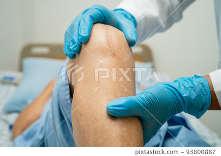 Asian senior or elderly old lady woman patient show her scars surgical total knee joint replacement Suture wound surgery arthroplasty on bed in nursing hospital ward, healthy strong medical concept. 93800887