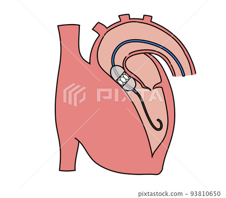 Transcatheter aortic valve placement 93810650