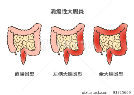 Ulcerative colitis - Stock Illustration [93815609] - PIXTA