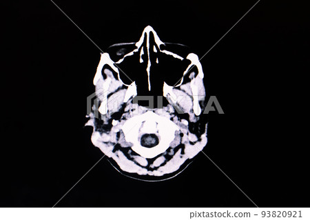 Image of computed tomography of the brain Image of computed tomography of the brain 93820921