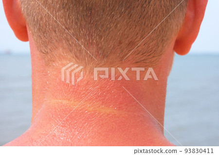 The man received sunburn on seashore. The skin 93830411