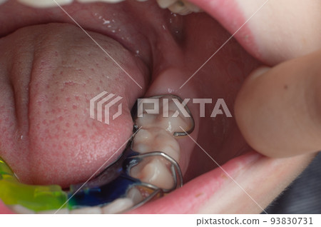 Mandibular plate, a boy wears a plate to align his teeth. Mandibular plate, a boy wears a plate to align his teeth. 93830731