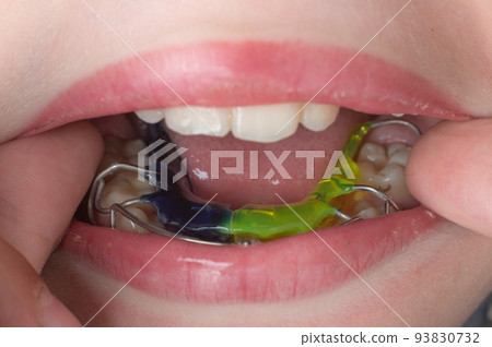 Mandibular plate, a boy wears a plate to align his teeth. Mandibular plate, a boy wears a plate to align his teeth. 93830732