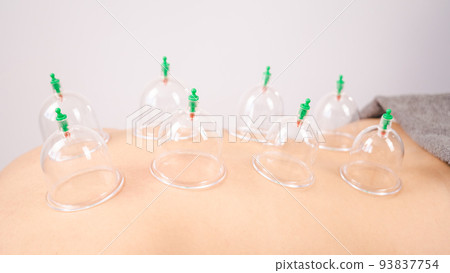 Female massage therapist uses vacuum cans on the patient's back. Female massage therapist uses vacuum cans on the patient's back. 93837754