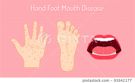 hand foot mouth disease. enteroviruses or EV71 is name of virus. be careful of your chidren and yourself. beautiful color background. vector illustration eps10 hand foot mouth disease. enteroviruses or EV71 is name of virus. be careful of your chidren and yourself. beautiful color background. vector illustration eps10 93842177