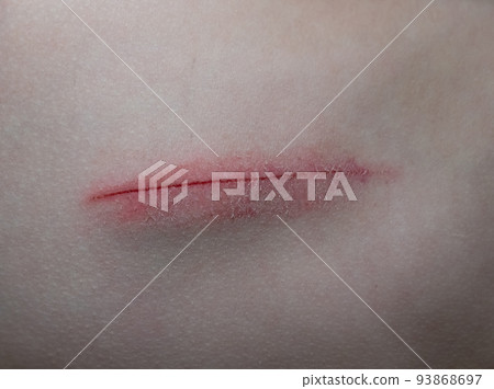 Skin abrasion or scratch on the abdomen. Medical abrasion, injury or wound 93868697