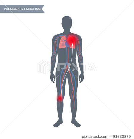 Pulmonary embolism disease Pulmonary embolism disease 93880879