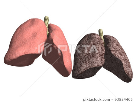 Normal lungs and discolored lungs due to smoking, cancer, etc. (3DCG image) Normal lungs and discolored lungs due to smoking, cancer, etc. (3DCG image) 93884405