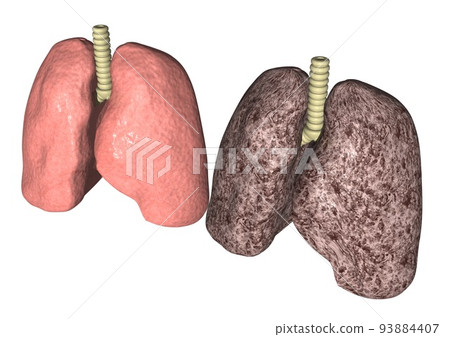 正常肺和因吸煙、癌症等而變色的肺（3DCG 圖像） 93884407