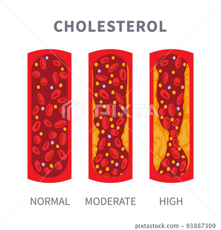 Normal and blocked artery with cholesterol clot infographics Normal and blocked artery with cholesterol clot infographics 93887309