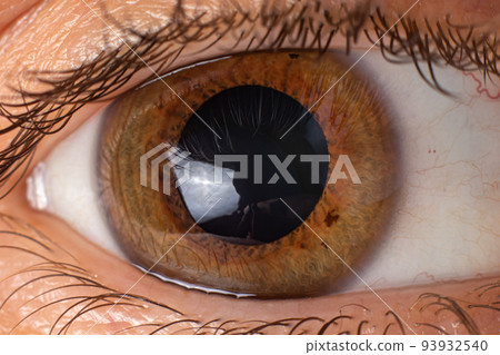 Keratoconus of eye, 4th degree. Contortion of the cornea in the form of a cone, deterioration of vision, astigmatism. Macro close up 93932540