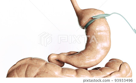 Stomach reduction 3 of 4- - Adjustable Gastric Band - AGB - 3D Rendering 93933496