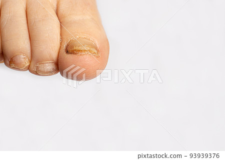 Fungus of nails on the big toe - dermatomycosis and onychomycosis, fungal infection macro photo. Dermatology, treatment of nail mycosis. Fungus of nails on the big toe - dermatomycosis and onychomycosis, fungal infection macro photo. Dermatology, treatment of nail mycosis. 93939376