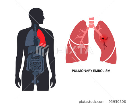 Pulmonary embolism disease 93950808