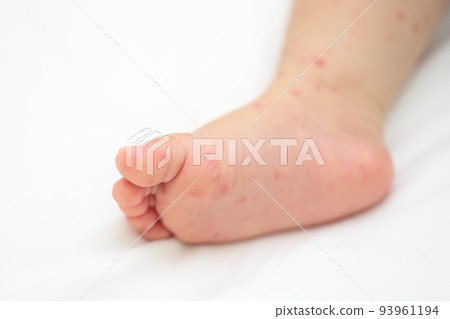 baby feet with hand foot and mouth disease baby feet with hand foot and mouth disease 93961194