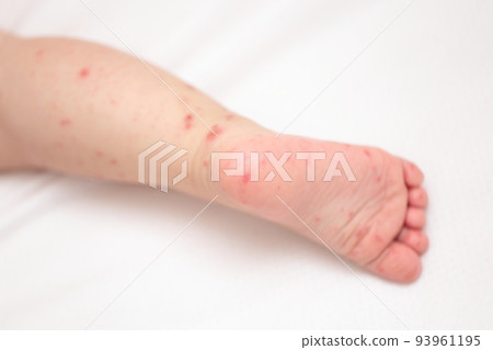 baby feet with hand foot and mouth disease baby feet with hand foot and mouth disease 93961195