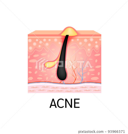 Ingrown hair. Hair has grown back into the skin surface after shaving. Formation of skin acne or pimple. Anatomy of hair and skin. Medical beauty skin care concept. On a white background. 3D vector. 93966371