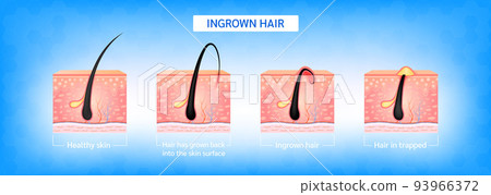 Ingrown hair. Hair has grown back into the skin surface after shaving. Formation of skin acne or pimple. Anatomy infographics of hair and skin. 93966372