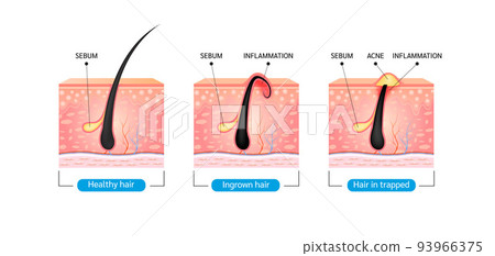 Ingrown hair. Hair has grown back into the skin surface after shaving. Formation of skin acne or pimple. Ingrown hair. Hair has grown back into the skin surface after shaving. Formation of skin acne or pimple. 93966375