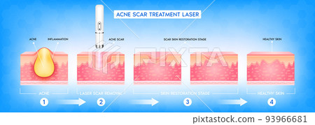Acne scar vascular laser treatment. Inflammation associated with pimples. The structure of the skin acne scar. Medical beauty skin care concept. 93966681