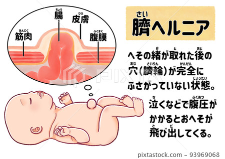 Baby's umbilical hernia - Easy-to-understand Japanese illustration 93969068