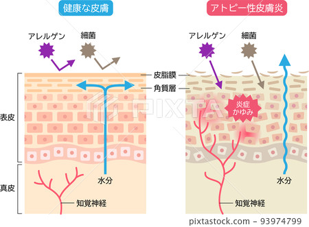 特應性皮炎和健康皮膚 皮膚細胞和橫截面 93974799