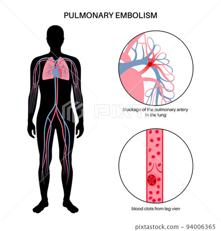 Pulmonary embolism disease Pulmonary embolism disease 94006365