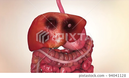 liver and colon cancer 3d medical liver and colon cancer 3d medical 94041128