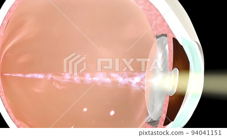 Anatomy of the Eye. Loss of vision in the eye Anatomy of the Eye. Loss of vision in the eye 94041151
