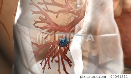 Tumor formation in human lungs. 94041211