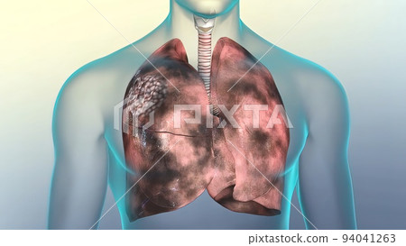Human respiratory system.Lungs damaged by smoking 94041263