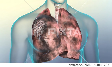 Human respiratory system.Lungs damaged by smoking 94041264