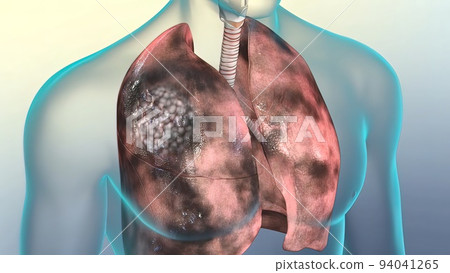 Human respiratory system.Lungs damaged by smoking 94041265