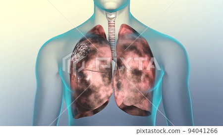 Human respiratory system.Lungs damaged by smoking Human respiratory system.Lungs damaged by smoking 94041266