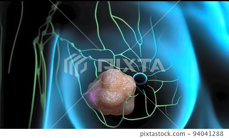 Interaction of tumor cells and lymphatic vessels in cancer 94041288