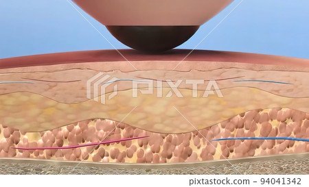 Laser Skin Resurfacing Surgery 3d medical 94041342