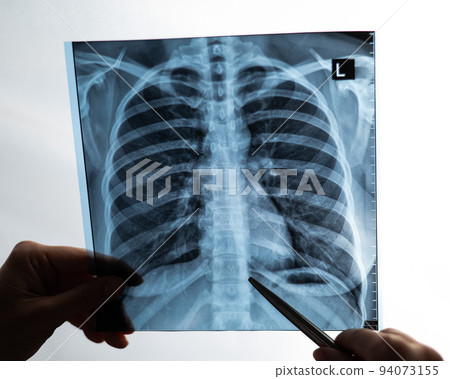 Doctor showing x-ray of patient's lungs.  94073155