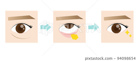 整容手術去除眼下脂肪 94098654