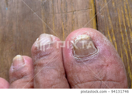 Big toe nails are fungal disease. 94131746