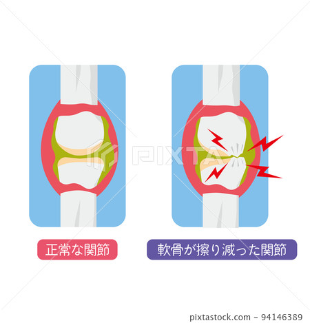 Illustration of a joint with worn out cartilage 94146389