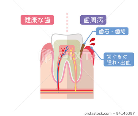 健康牙齒和牙周病牙齒的解釋 94146397