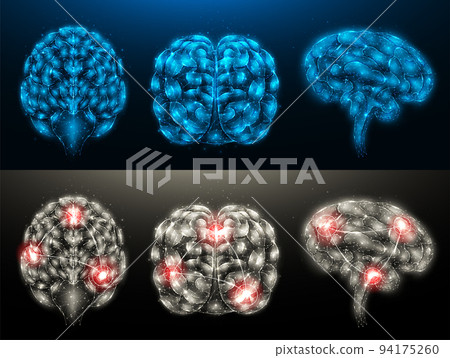 Set of polygonal vector illustrations of a healthy brain and a diseased brain with foci of inflammation. Nervous system medical banner, template or background. 94175260
