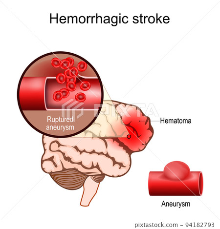 Hemorrhagic stroke. Human brain with Hematoma 94182793