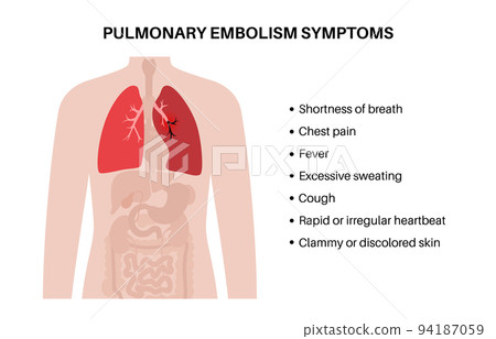 Pulmonary embolism disease Pulmonary embolism disease 94187059