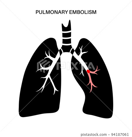 Pulmonary embolism disease 94187061