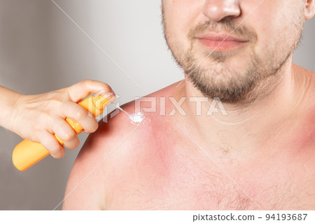 Applying sunscreen or therapeutic spray to the skin of a man with a sunburn 94193687