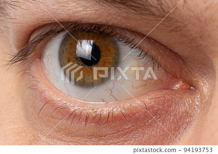 Pinguecula eyes macro photo close-up of the male eye. Yellow education on squirrel, farmer's eye 94193753