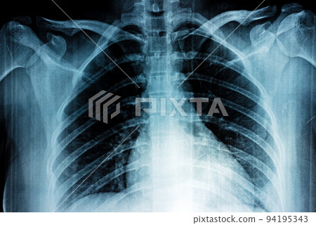 Film X-ray Film X-ray 94195343